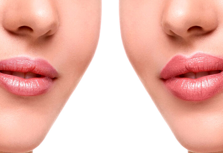 Contorno de Labios y Líneas de Expresión