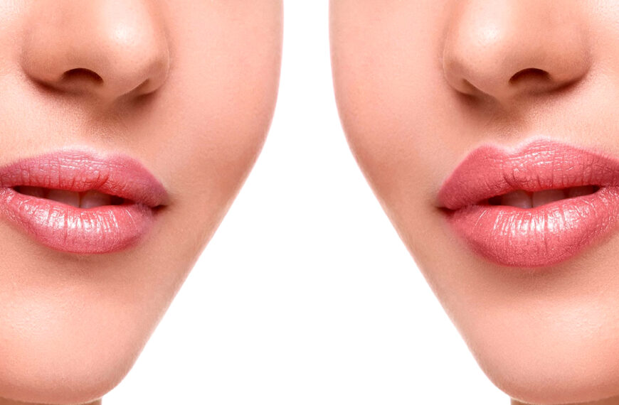 Contorno de Labios y Líneas de Expresión