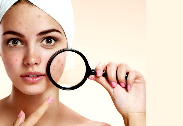 Tratamiento del Acné