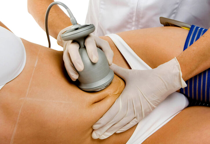 Cavix (Ultracavitación)